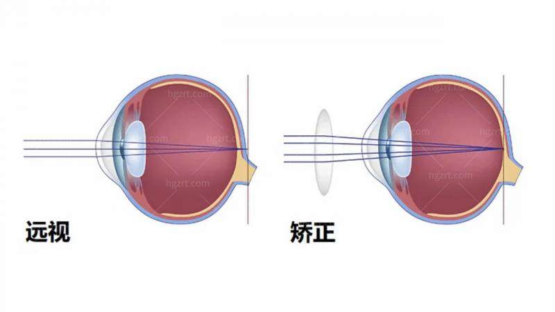 韩国S&B眼科真人口碑评价怎么样？