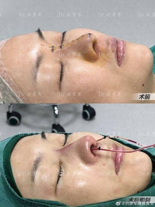 盐城曼丽莎整形美容医院真人口碑评价怎么样？