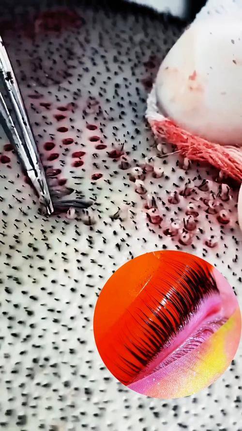 韩国MOEM毛发移植医院特色项目及技术优势