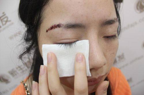 韩国MOEM毛发移植医院真人口碑评价怎么样?