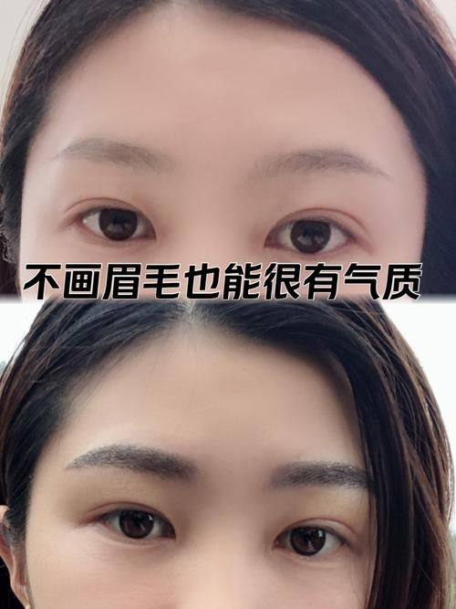 韩国MOEM毛发移植医院是正规医院吗?