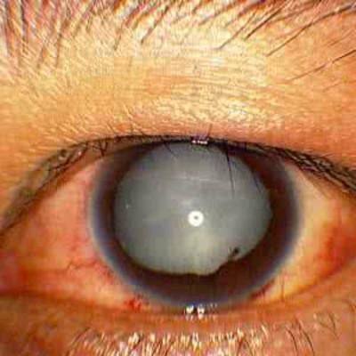 柳州红十字会眼科医院收费价格表/收费标准