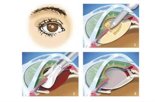 淮南市第一人民医院眼科详细的预约挂号方式及流程