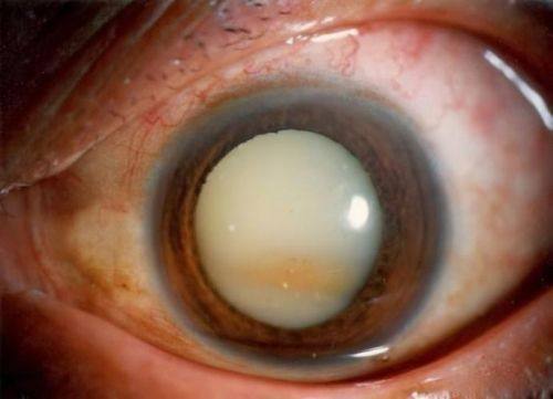 武汉汉口爱尔眼科医院真人口碑评价怎么样？