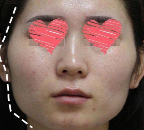 日本LiraCranio面部诊所特色项目及技术优势