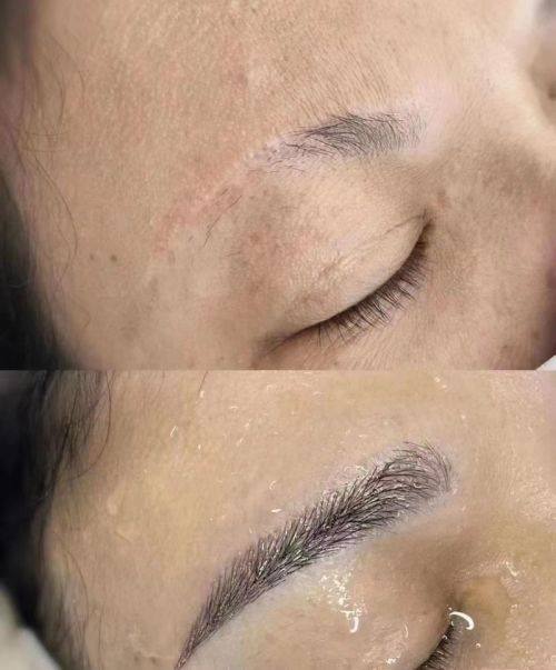 武汉大麦科发源微针植发医院特色项目及技术优势