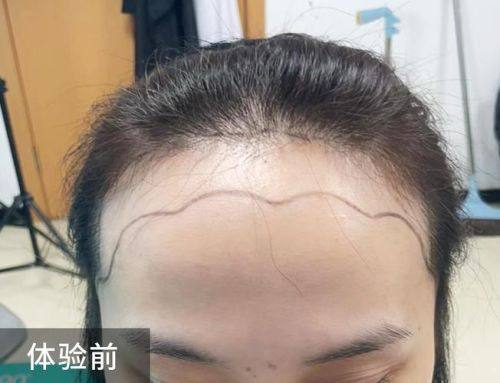 武汉大麦科发源微针植发医院真人口碑评价怎么样？