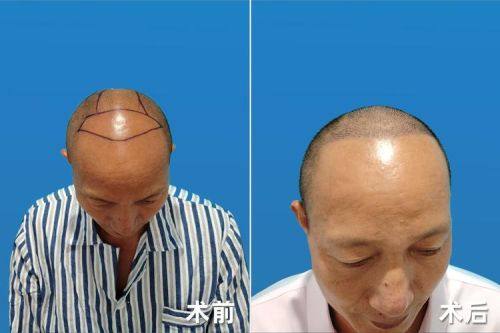 武汉大麦科发源微针植发医院收费价格表/收费标准