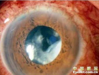 杭州市红十字会医院眼科是正规医院吗？