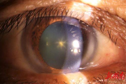 中山火炬开发区人民医院眼科医生团队实力强大及骨干医生简介