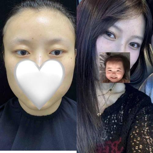 贵阳奥黛丽整形医院真人口碑评价怎么样？