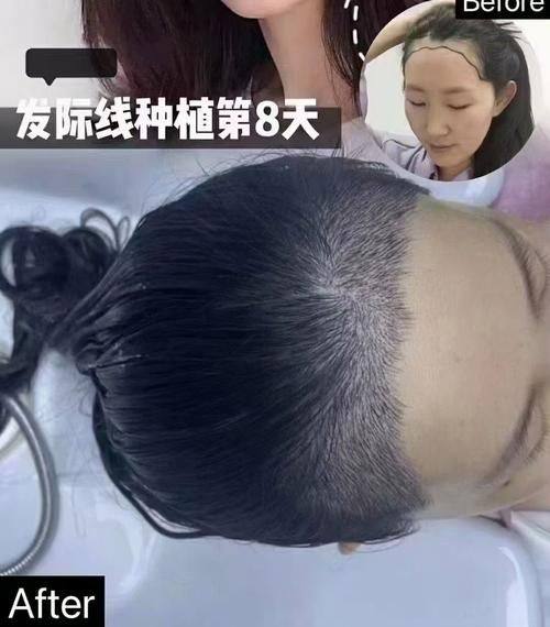 呼和浩特宜兴医院植发是正规医院吗？