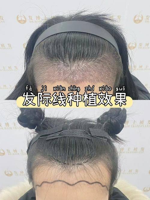 呼和浩特宜兴医院植发真人口碑评价怎么样？