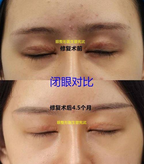 长春鑫至美整形医院真人口碑评价怎么样？