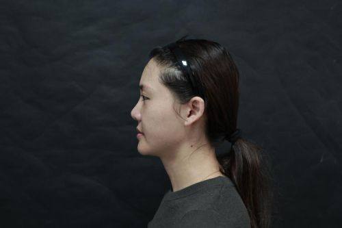 温州极丽整形真人口碑评价怎么样？