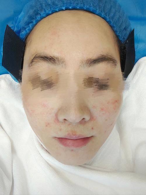 韩国Brandnew整形医院真人口碑评价怎么样？